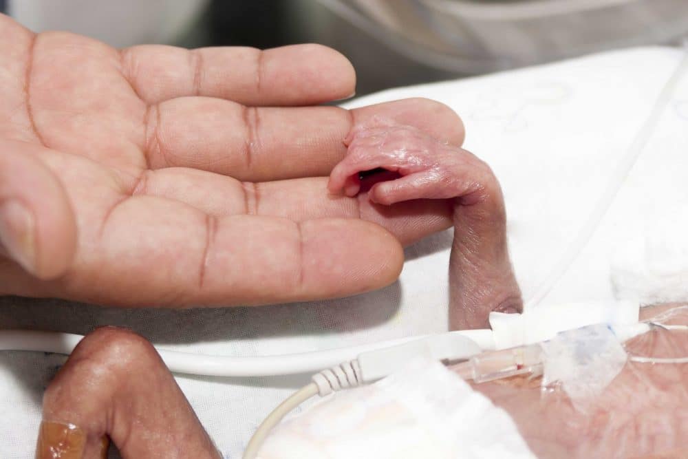 Video Impresionante De Un Bebe Prematuro Durante 107 Dias En La Uci Etapa Infantil